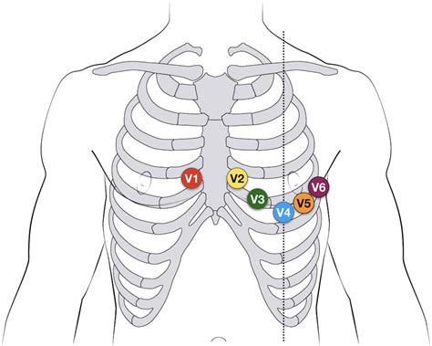 where to place ecg leads