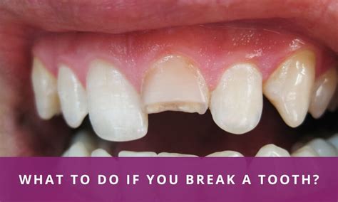 Where To Put A Broken Tooth
