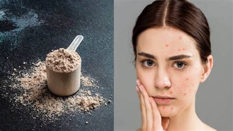 Whey Isolate Cause Acne