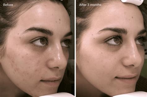 Chemical Peels for Acne Scars Efficacy, Before and Afters, AtHome Uses