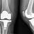 which is worse acl surgery or knee replacement