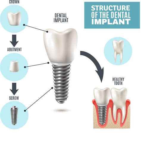 How Do Dental Implants Work? Dorset Dental Implants