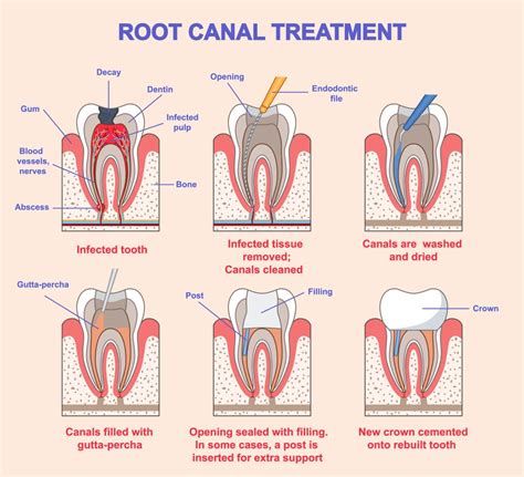 Root canal dentistry Stock Image M780/0565 Science Photo Library