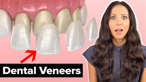 Dental Bonding vs Veneers The James Clinic