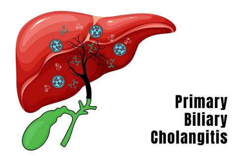 which factor would cause primary biliary cholangitis