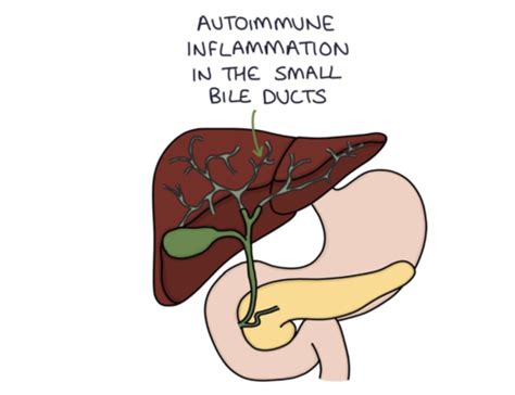 which factor would cause primary biliary cholangitis quizlet
