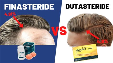 which is better finasteride or dutasteride