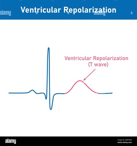 which wave in ecg represents ventricular repolarization