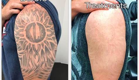 White Skin After Laser Tattoo Removal Best Overview Helpful For Before And