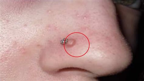white bump inside nostril piercing