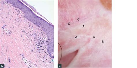 Understanding a White Bump on Labia: Causes and Concerns