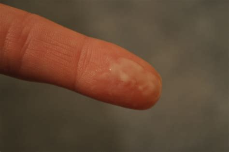 White Cloudy Clumpy Discharge