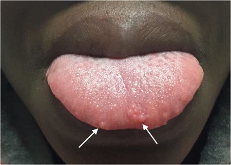 white dots on tip of tongue