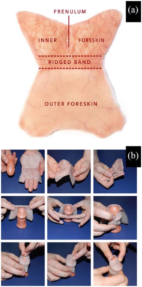 White Layer On Foreskin