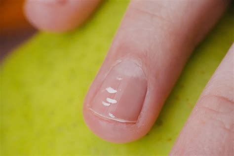 White Line Inside Nail