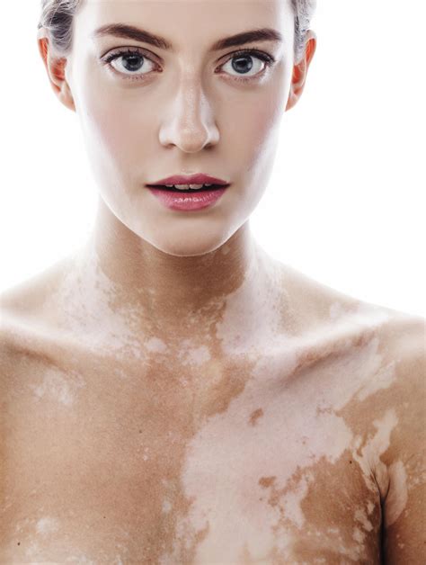 white model with vitiligo