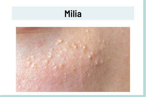 Understanding and Treating White Skin Bumps Effectively Today