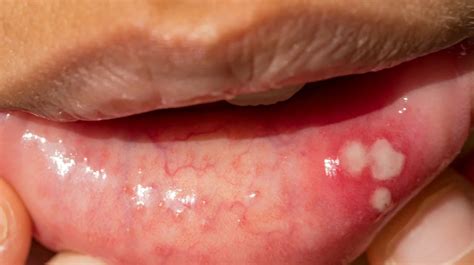 What Causes a White Sore Inside Your Mouth and How to Treat It Effectively