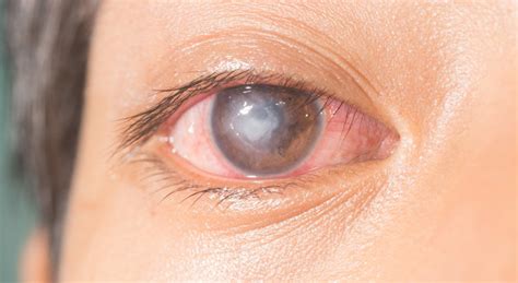 What is a White Spot in the Eye: Causes, Symptoms, and Treatment Options