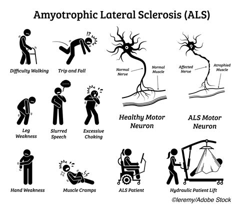 who was recently diagnosed with als