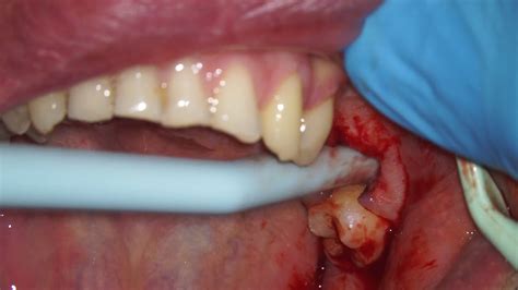 Extracted infected primary tooth with visible apical lesions