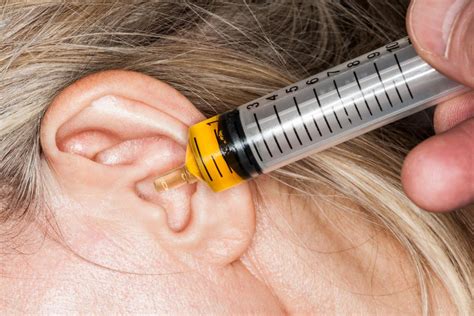 Woman's Clogged Ear with Massive Earwax is Finally Removed YouTube