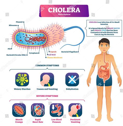 Why Cholera Is Caused