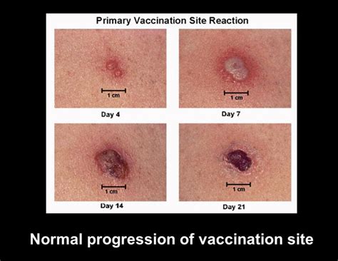Why Cold Compress After Vaccination