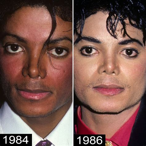 why did michael jackson's skin color change