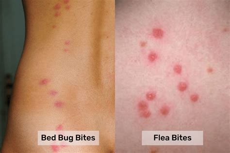 Why Do Bed Bugs Bite In A Triangle
