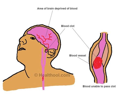 Why Do Clots Form In Brain