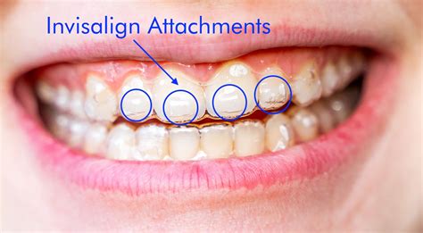 Dentist NYC Invisalign Dentist NYC Sachar Dental NYC
