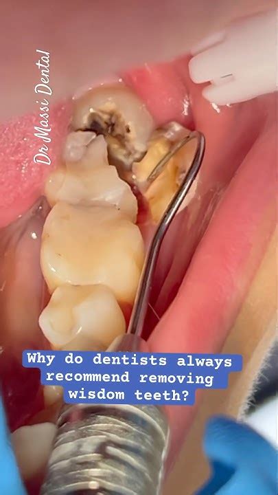 10 Best Tips To Prevent Wisdom Tooth Extraction Complications