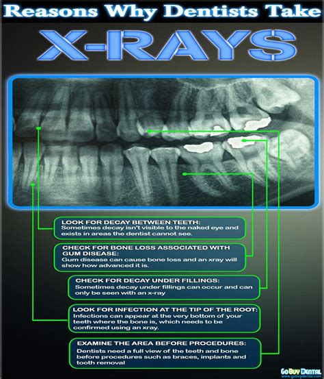 Dental XRays What You Need to Know Greenspoint Dental Houston Dentist