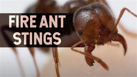 why do fire ants hurt so bad