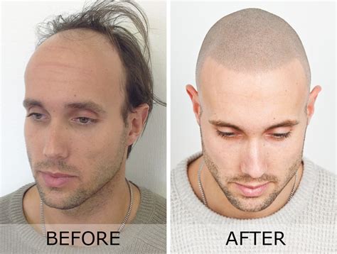 Why Do Guys Lose Hair On The Top Of Their Head 