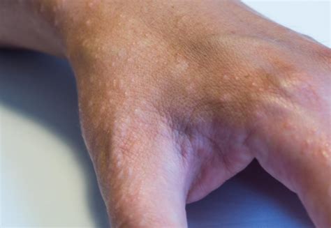why do i get eczema on one hand