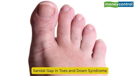 Why Do I Have A Toe Gap