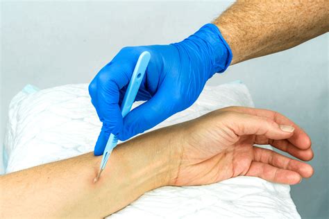 Why Do I Keep On Getting Abscesses