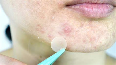 Why Do I Keep On Getting Whiteheads