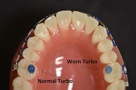 Why Do My Bite Blocks Hurt