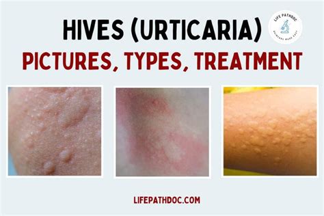 why do my hives not itch