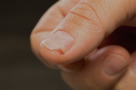 Why Do Nails Break In Layers