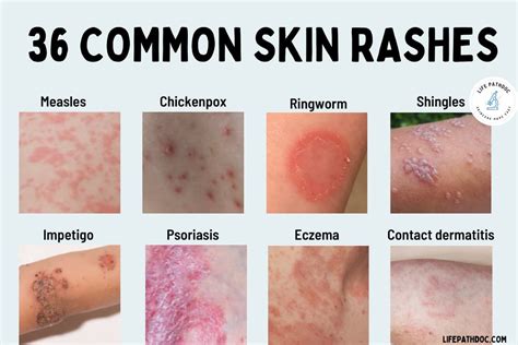 why do skin rashes spread