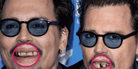 why does johnny depp have such bad teeth