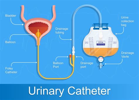 Why Does My Catheter Keep Blocking