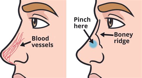 Why Does My Nose Bleed: Causes and Quick Fixes Explained
