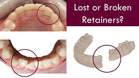 Why Does My Retainer Smell