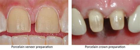 Why Does My Tooth Veneer Keep Falling Off