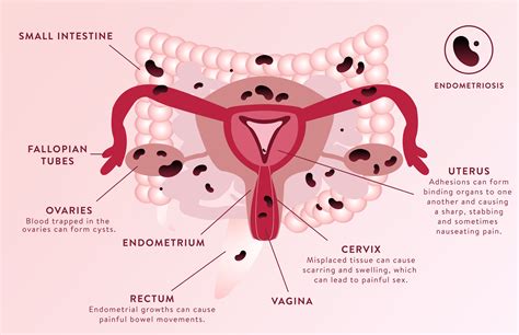 why does sex hurt with endometriosis